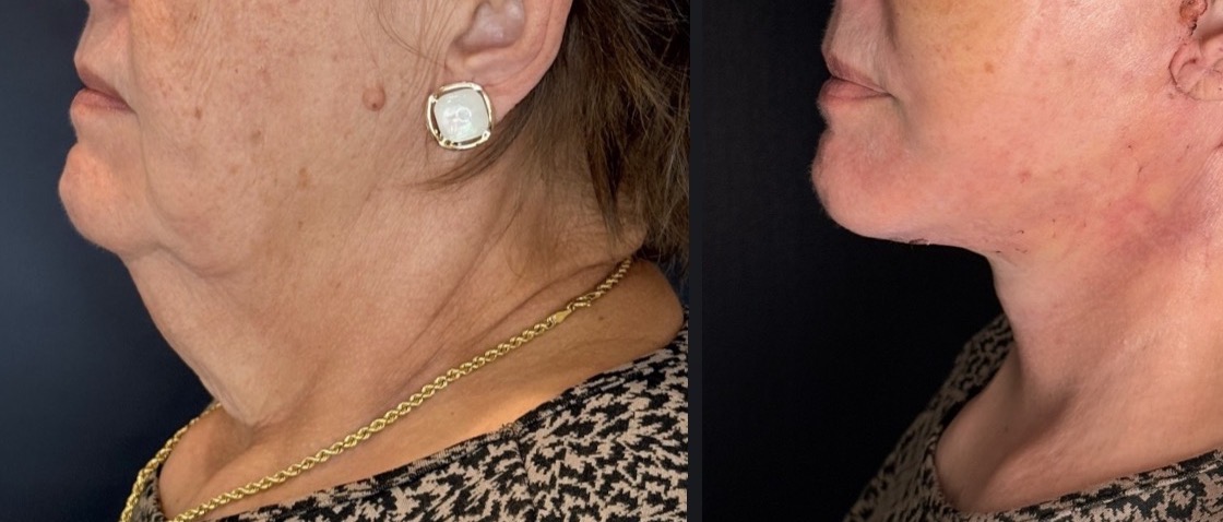 Antes e depois — Necklift caso 1