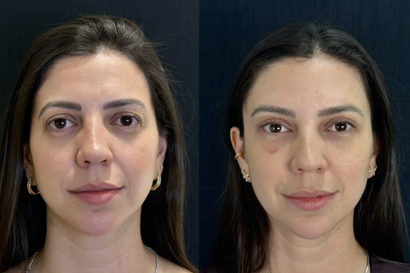 Antes e depois — Lifting de supercílio endoscópico, caso 6