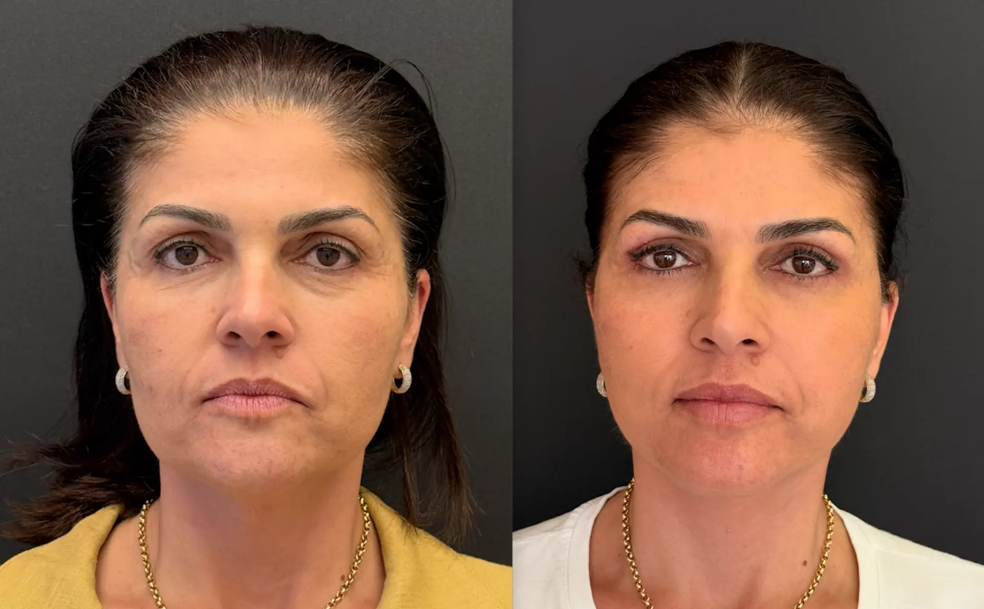 Antes e depois — Lifting de Face Deep Plane, caso 6