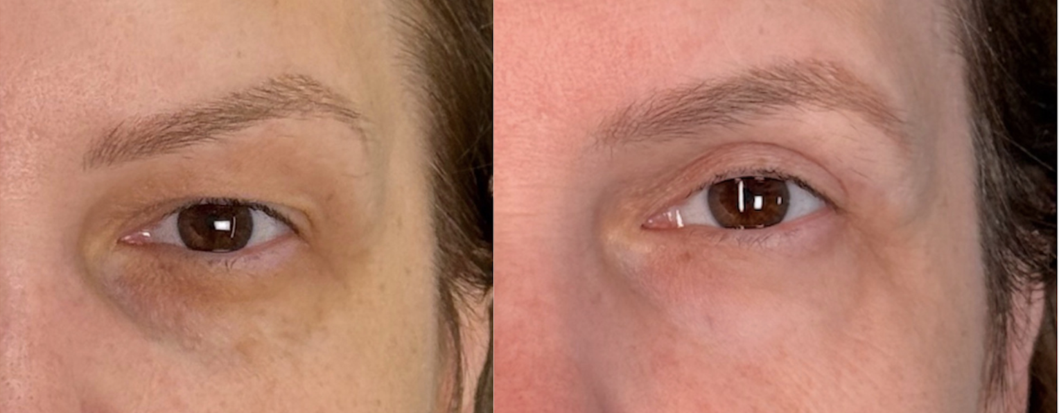 Antes e depois — tratamento de olheiras caso 2
