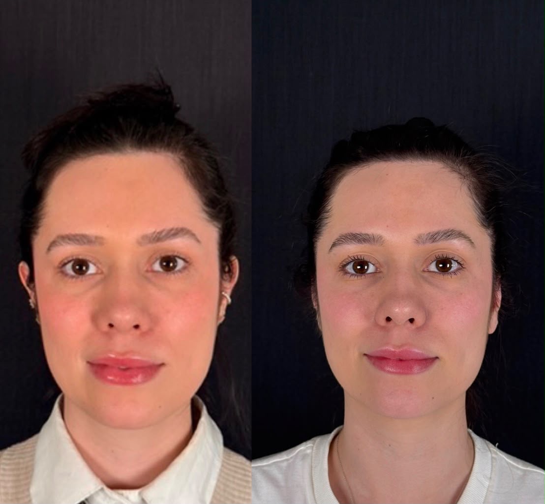 Antes e depois — Otoplastia, caso 2