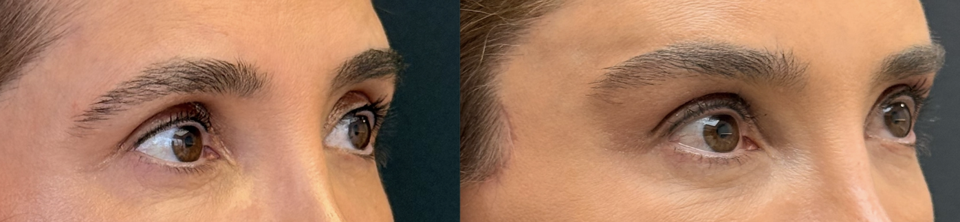 Antes e depois — Lifting de supercílio endoscópico, caso 9