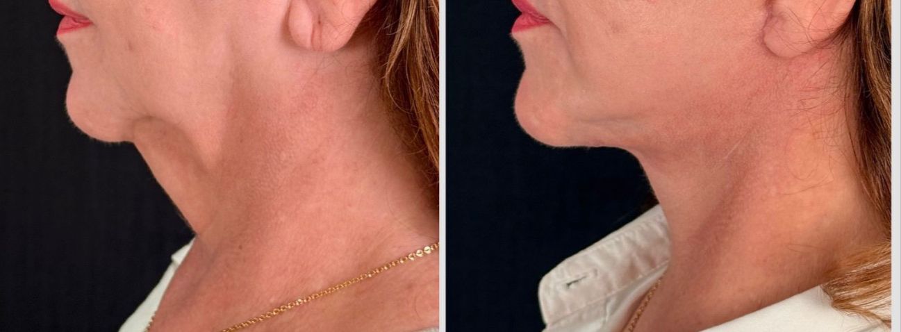Antes e depois — Necklift caso 2