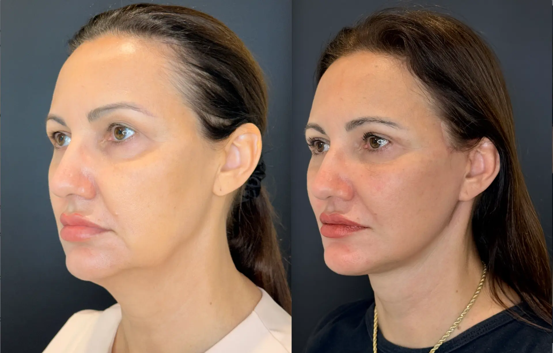Antes e depois — Lifting de Face Deep Plane, caso 9