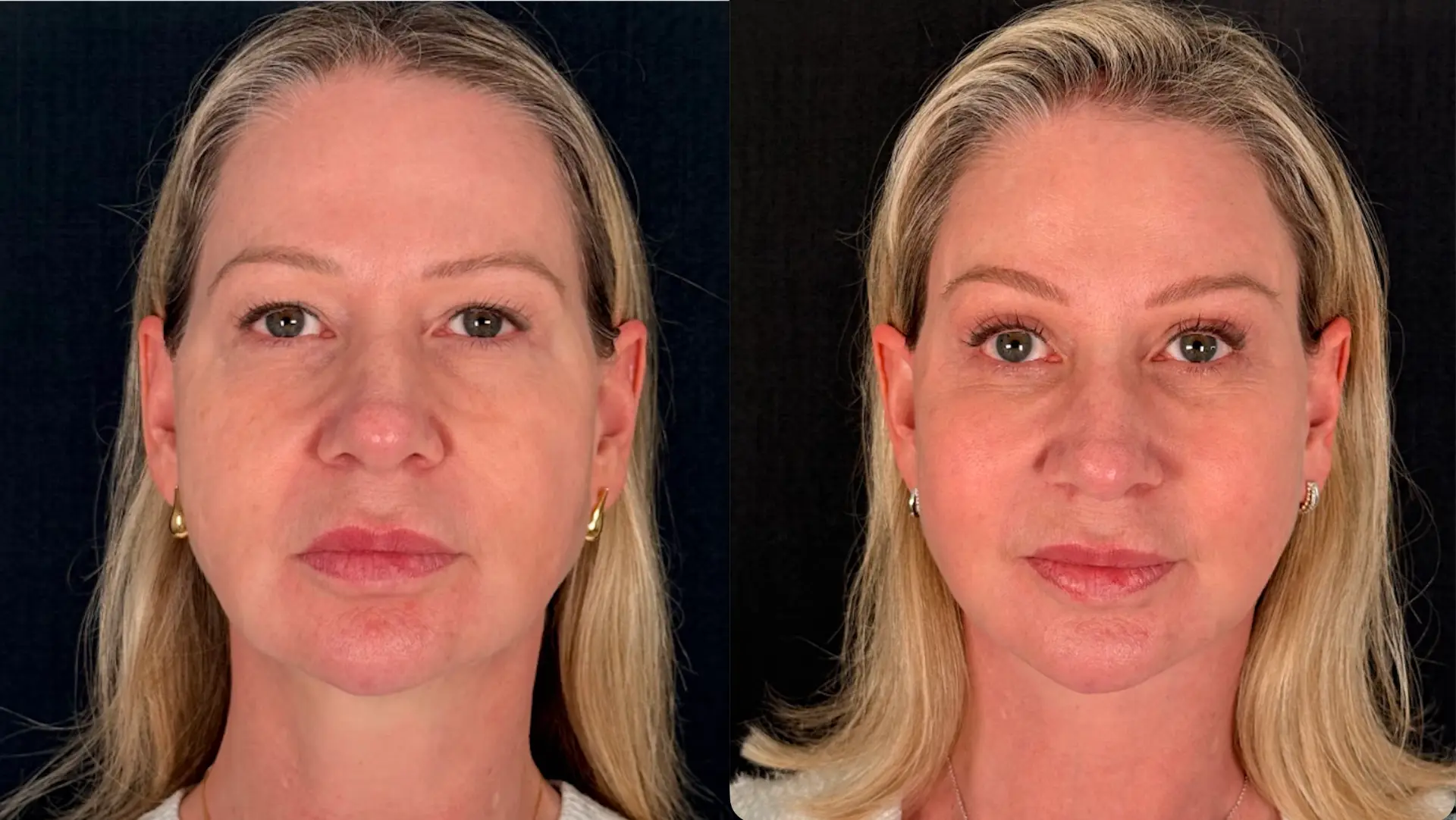 Antes e depois — Lifting de Face Deep Plane, caso 8