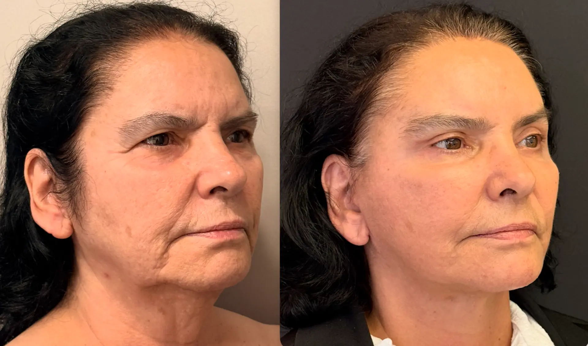 Antes e depois — Lifting de Face Deep Plane, caso 2