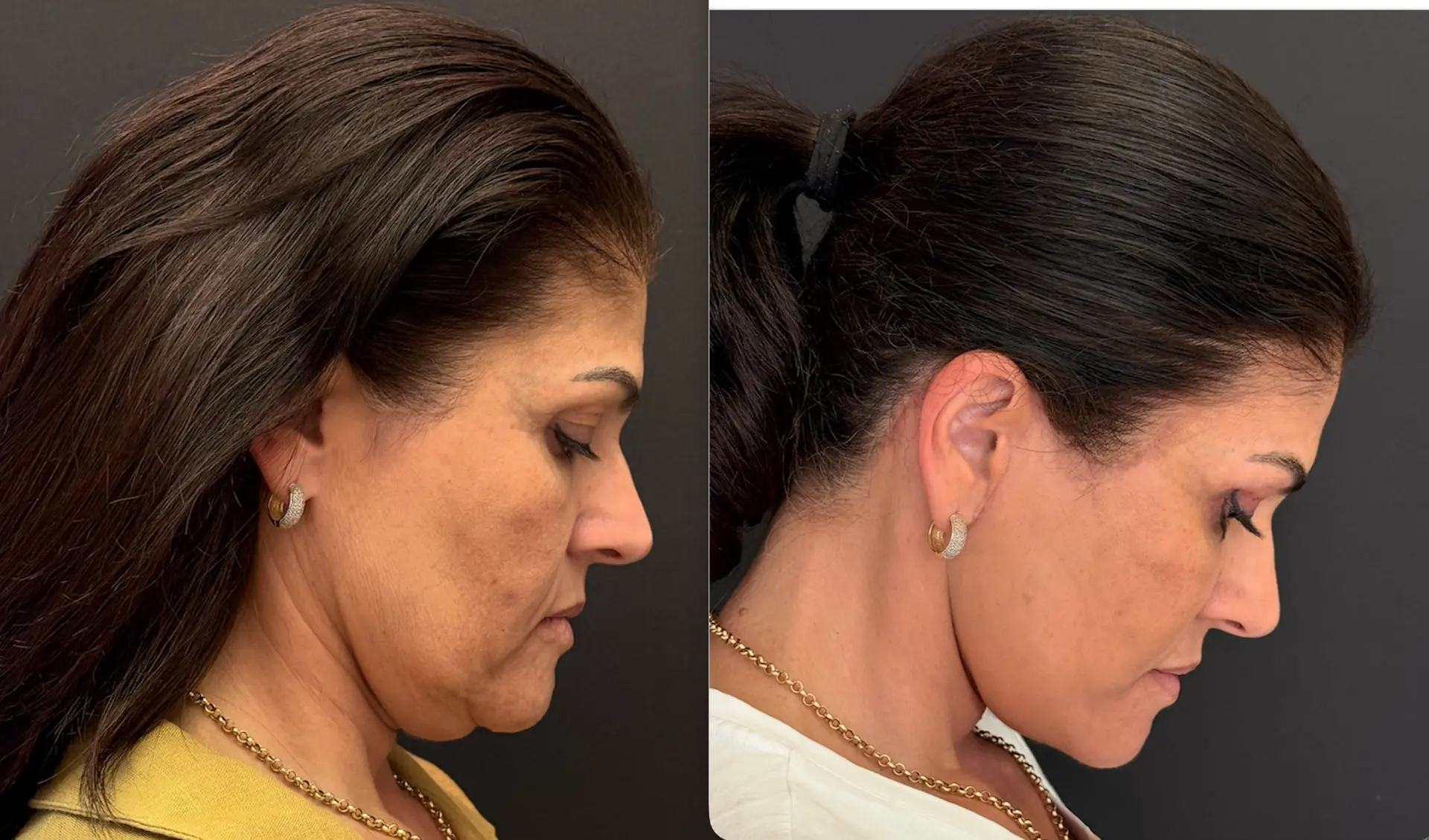 Antes e depois — Lifting de Face Deep Plane, caso 3
