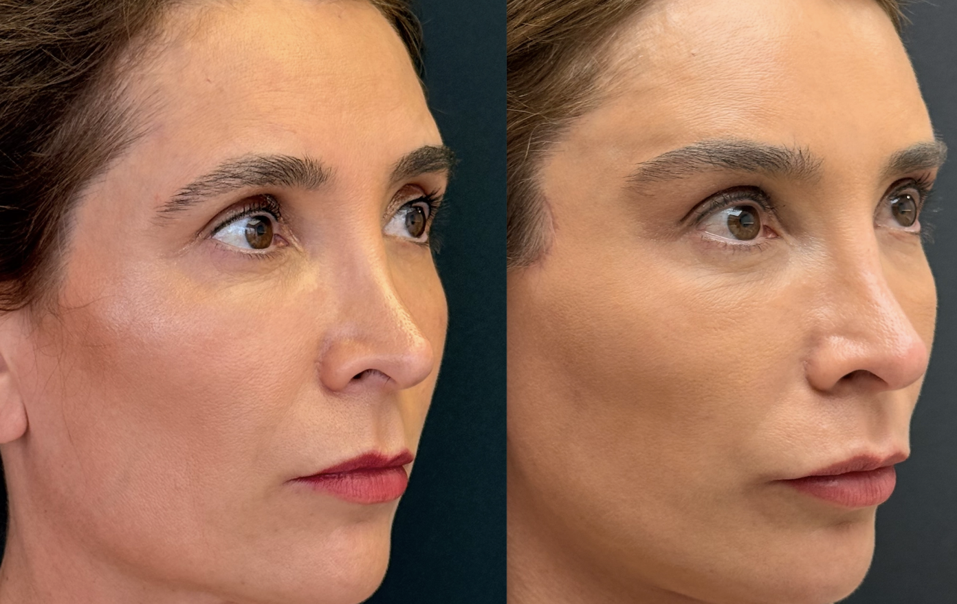 Antes e depois — Lifting de supercílio endoscópico, caso 7