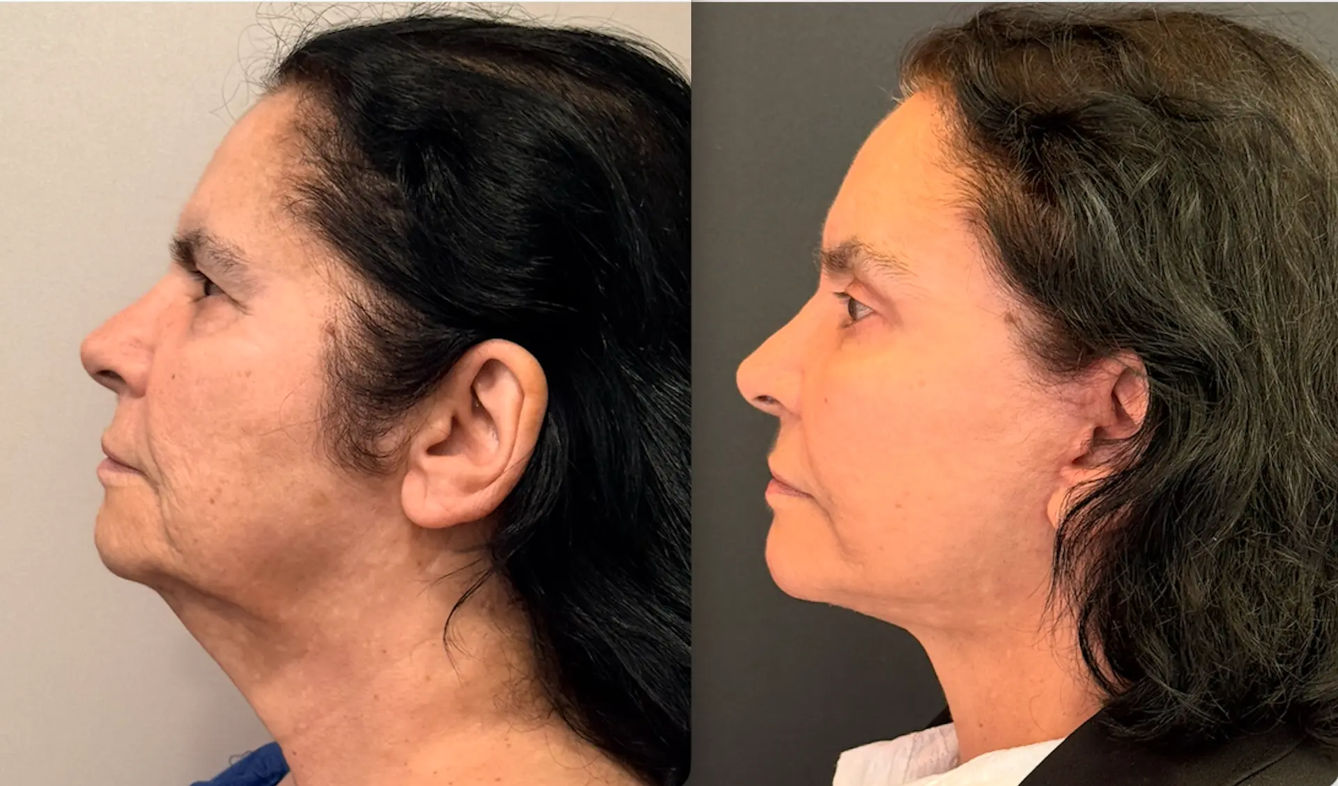 Antes e depois — Lifting de Face Deep Plane, caso 1
