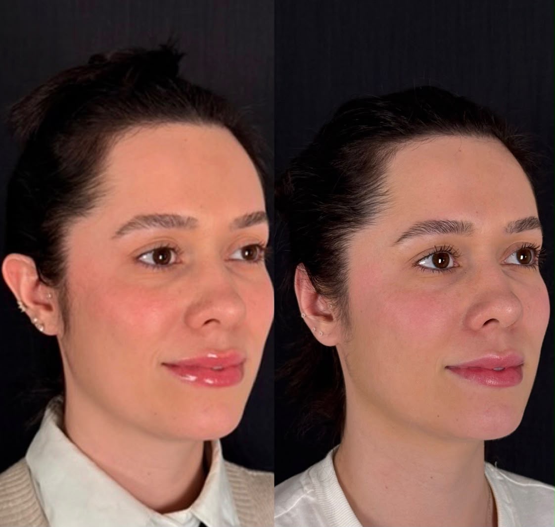 Antes e depois — Otoplastia, caso 1