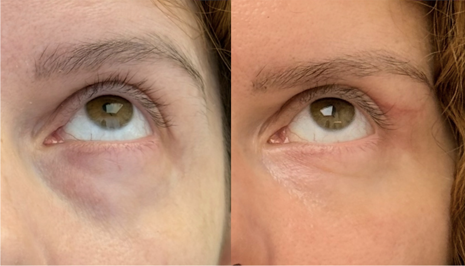 Antes e depois — tratamento de olheiras caso 1
