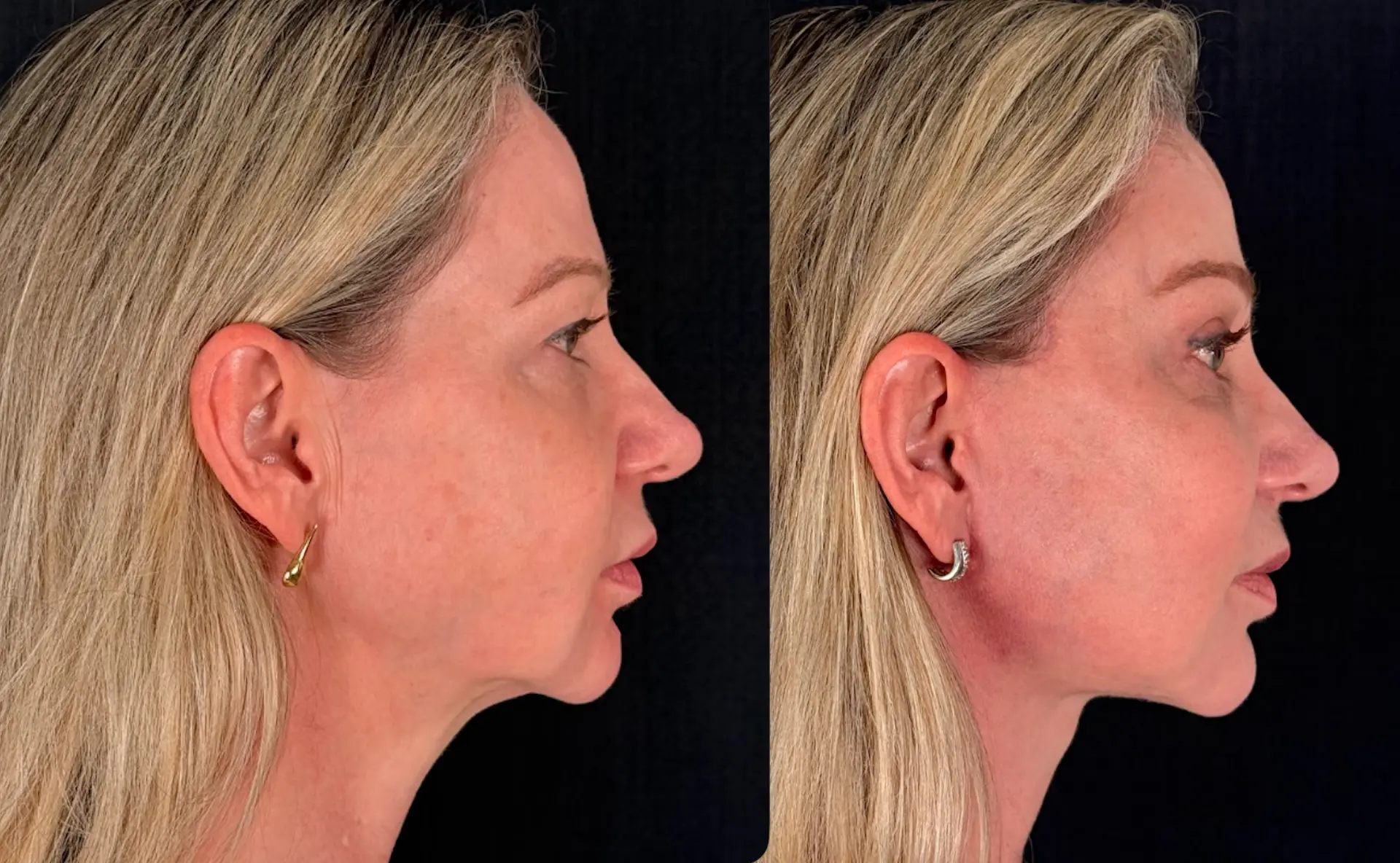 Antes e depois — Lifting de supercílio endoscópico, caso 5