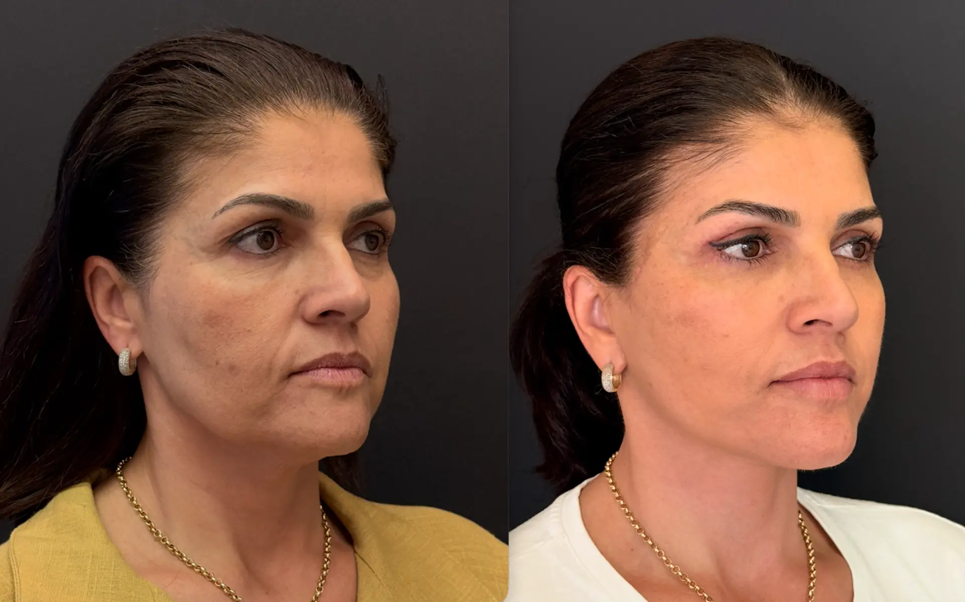 Antes e depois — Lifting de Face Deep Plane, caso 5