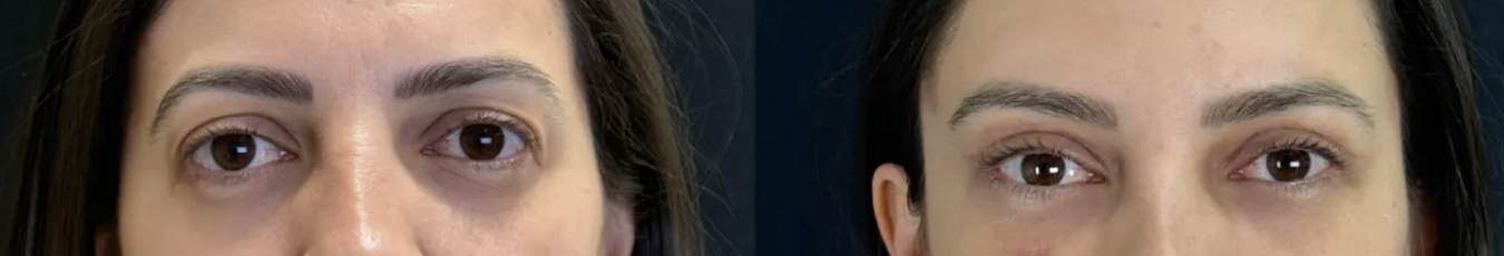 Antes e depois — Lifting de supercílio endoscópico, caso 8