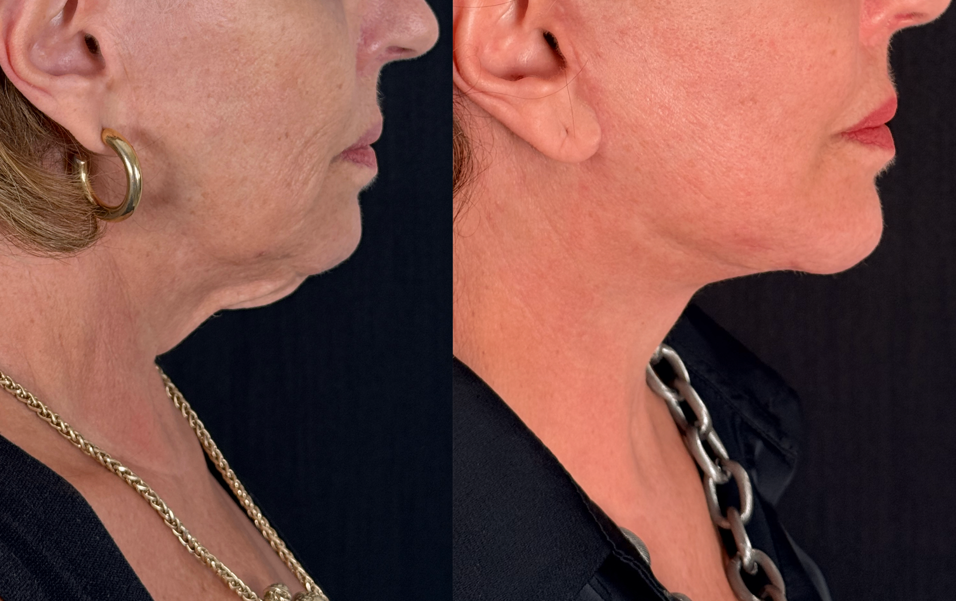 Antes e depois — Necklift caso 4