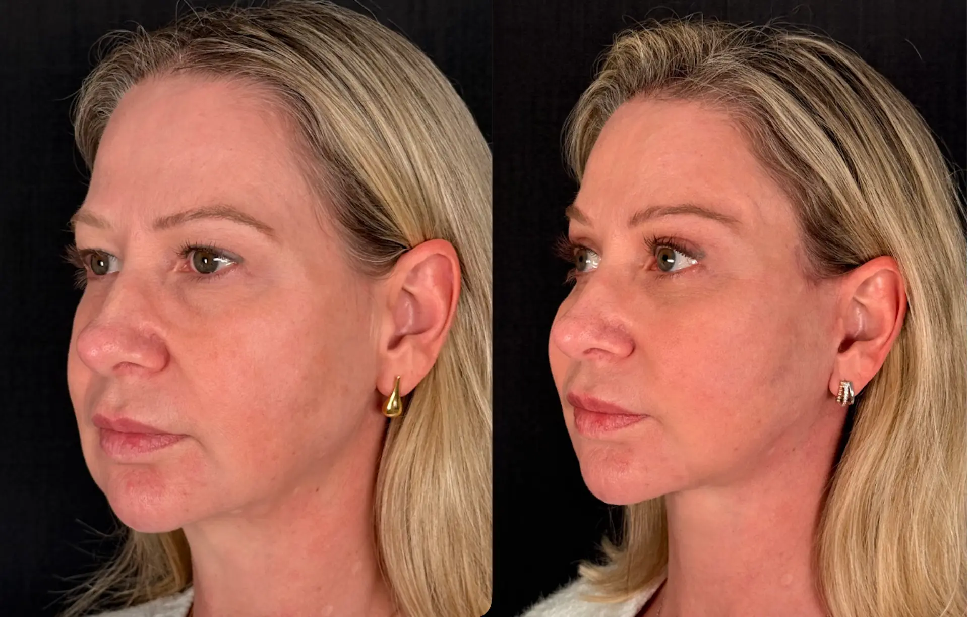 Antes e depois — Lifting de Face Deep Plane, caso 7