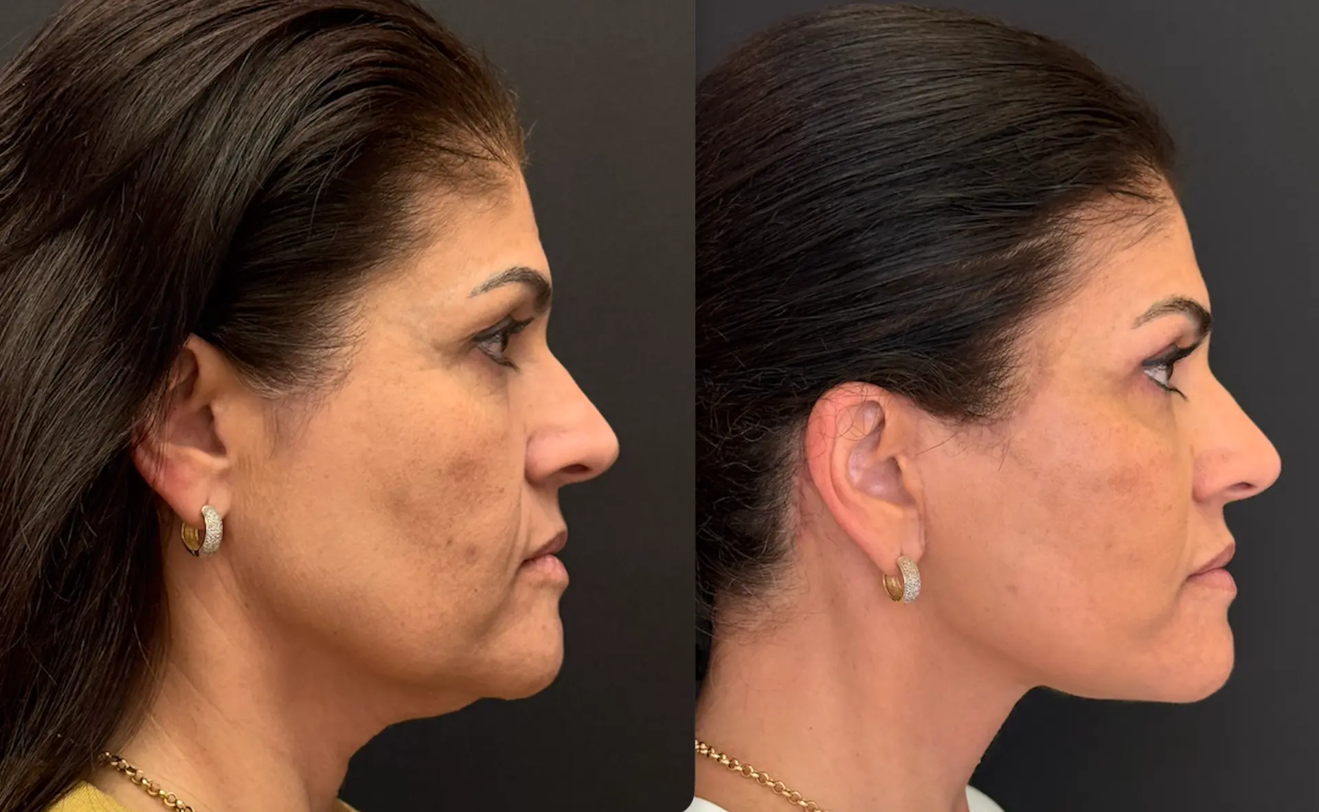 Antes e depois — Lifting de Face Deep Plane, caso 4