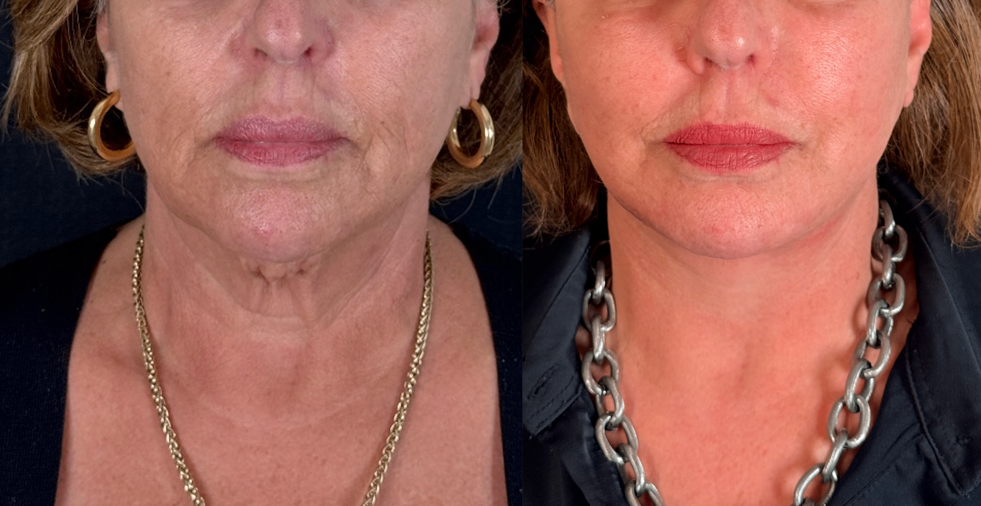 Antes e depois — Necklift caso 3