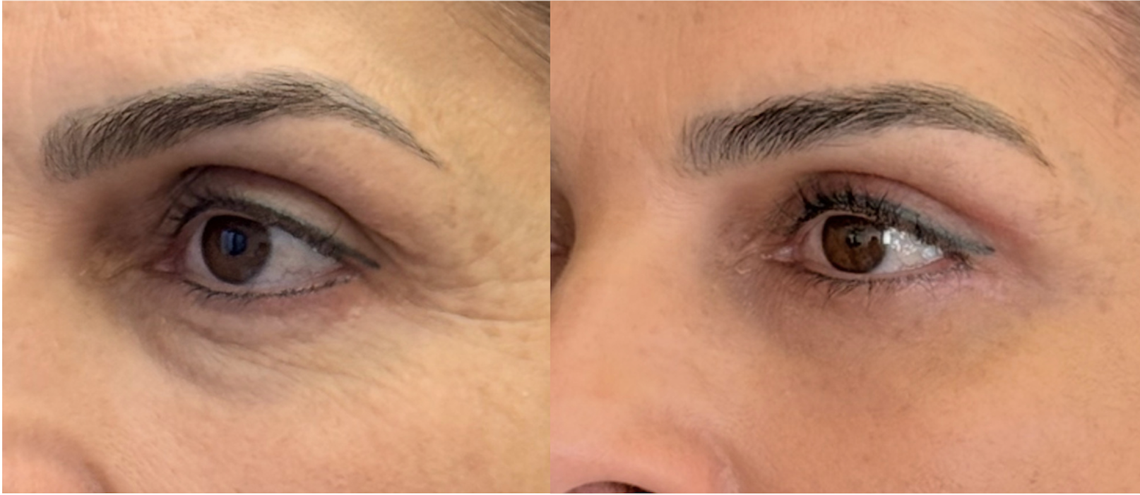 Antes e depois — tratamento de olheiras caso 3
