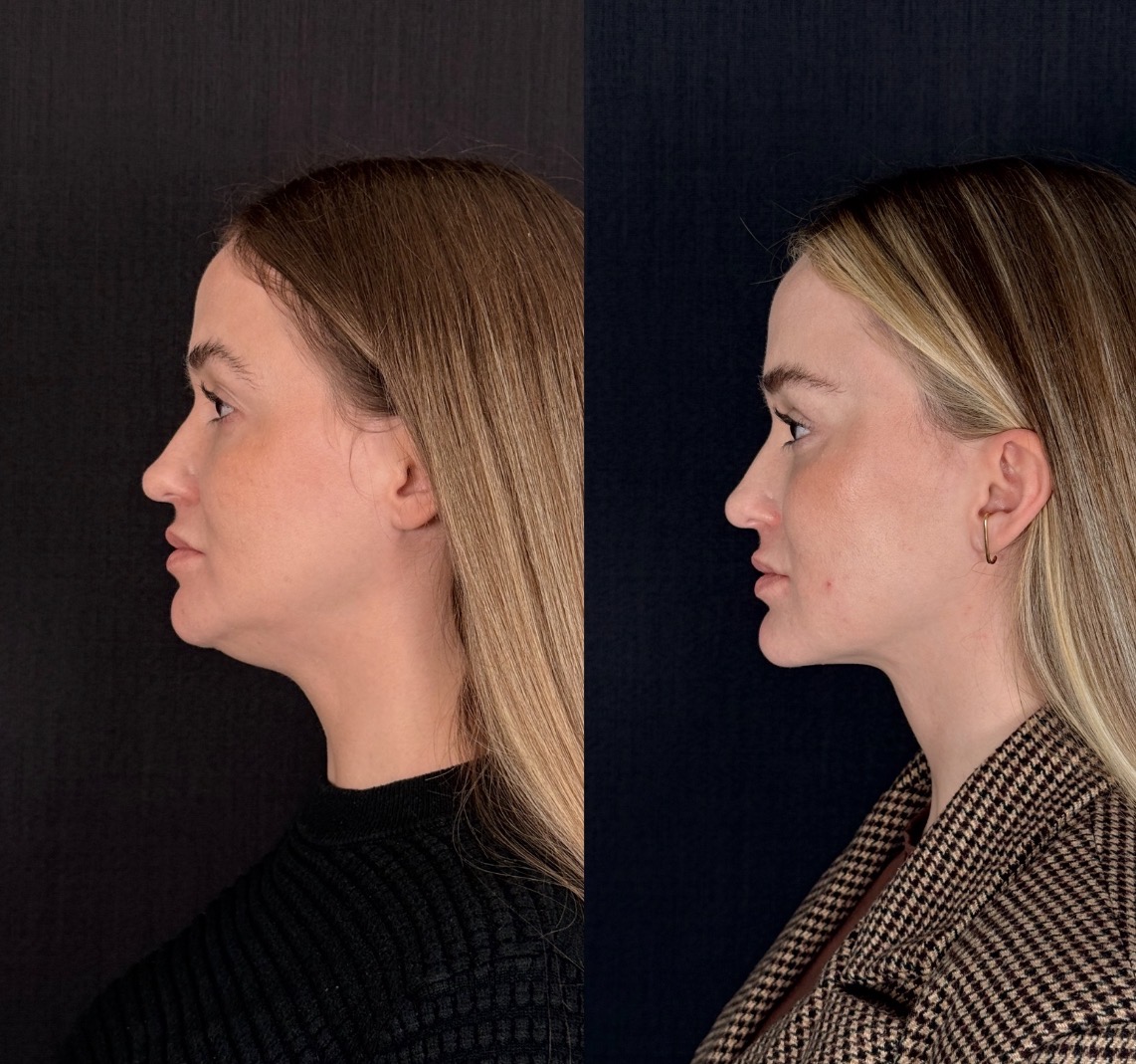 Antes e depois — Necklift caso 1